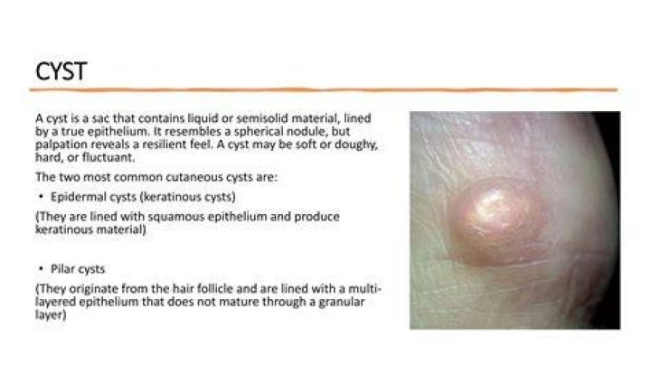 Are cysts hard?
