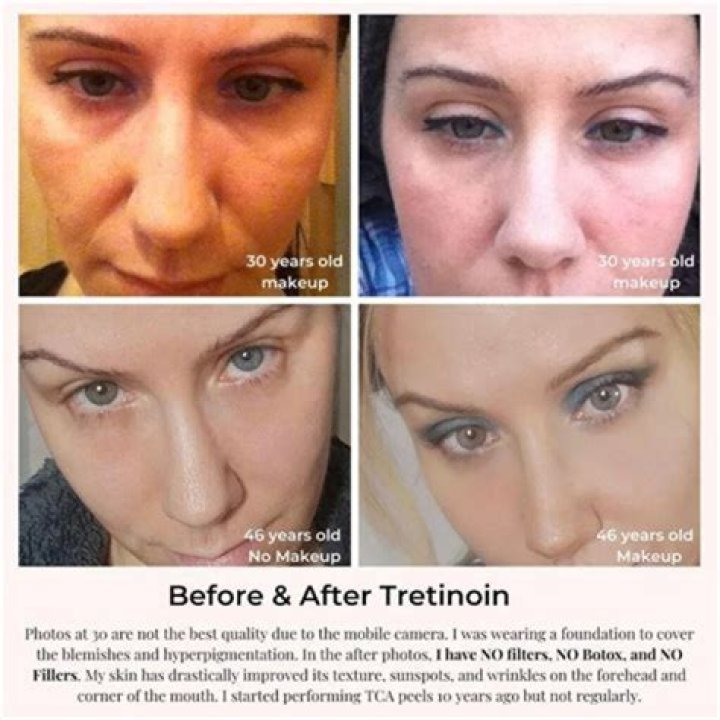 Can retinol cause permanent damage?