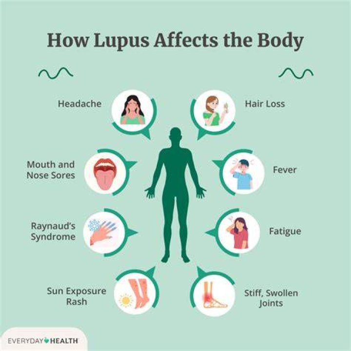 Can you go in the sun with lupus?