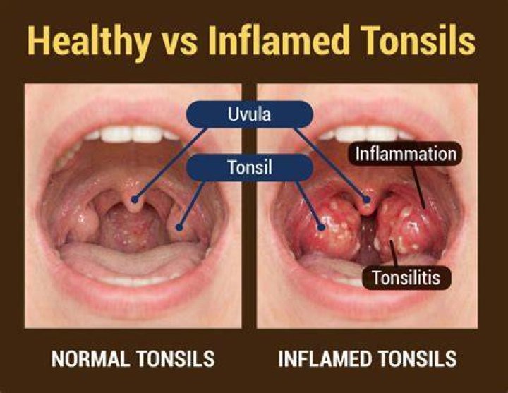 Do they cauterize tonsils?
