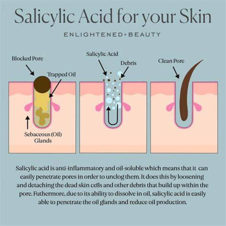 Does salicylic acid make acne worse before it gets better?