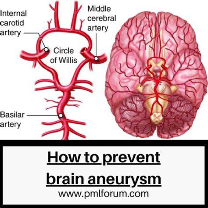 How can you prevent brain aneurysms?