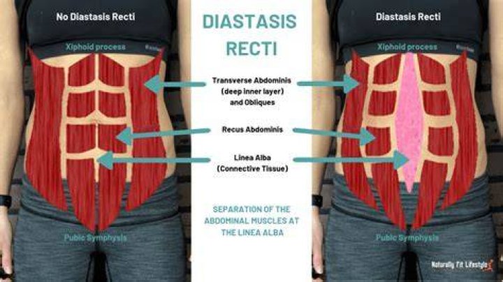 How do I know if I have diastasis recti?
