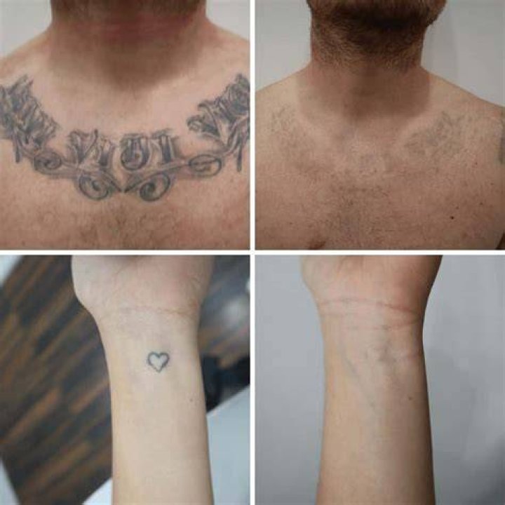 How expensive is laser tattoo removal?