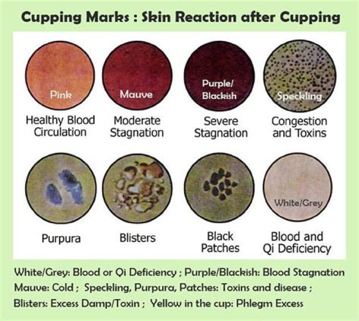 How long should cupping last?