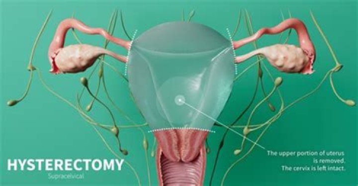 How should you lay in bed after a hysterectomy?