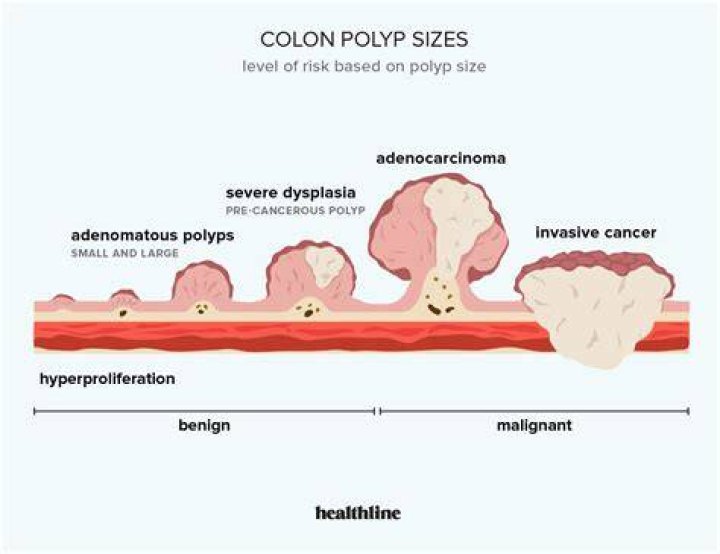 Is a 9mm polyp big?