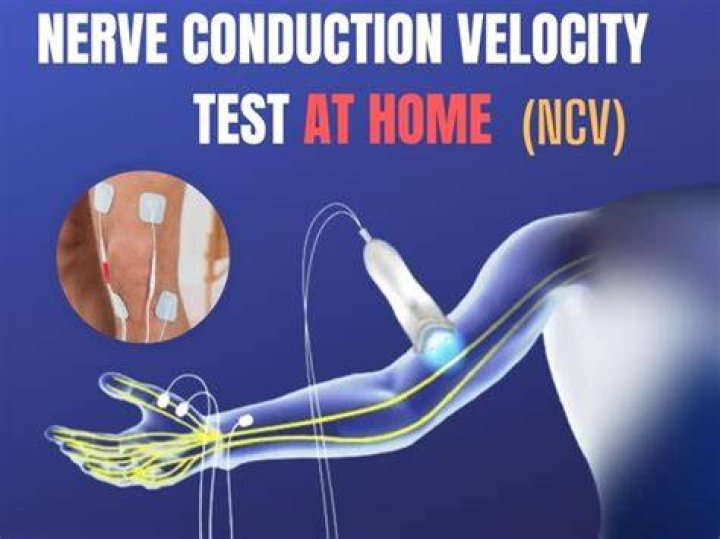 What are the side effects of a nerve conduction test?