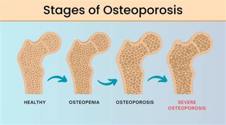 What are the three stages of osteoporosis?