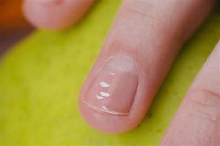 What are the white things on your nails?