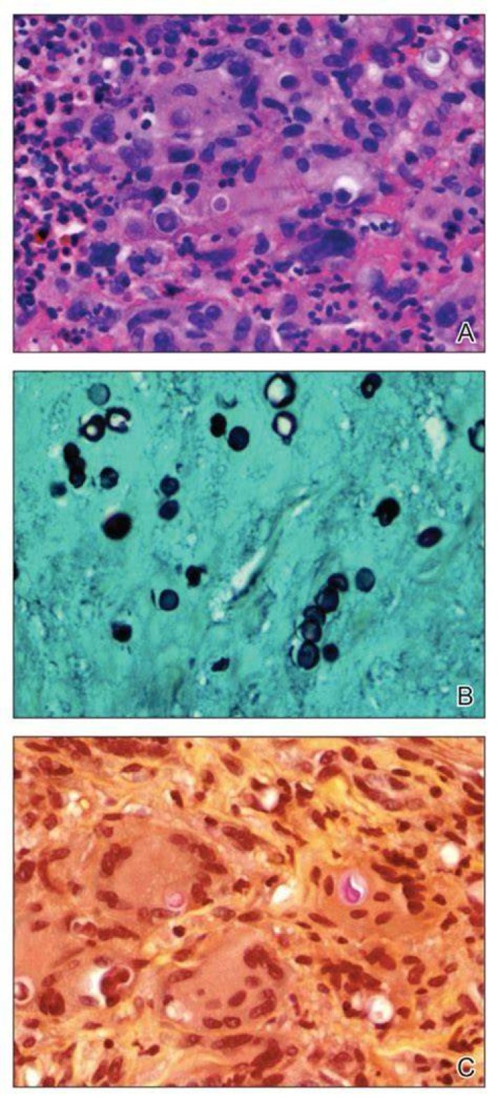 What color is blastomycosis?