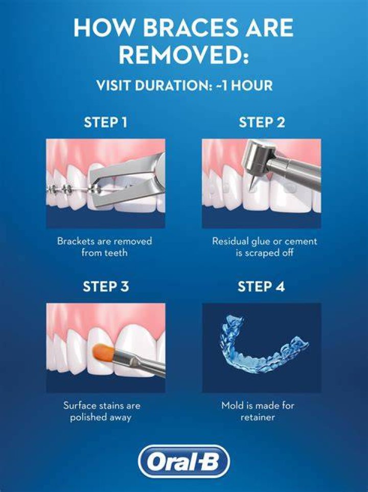 What do orthodontists do when taking braces off?