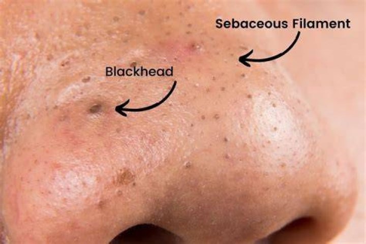 What does it mean when you have a blackhead in your ear?