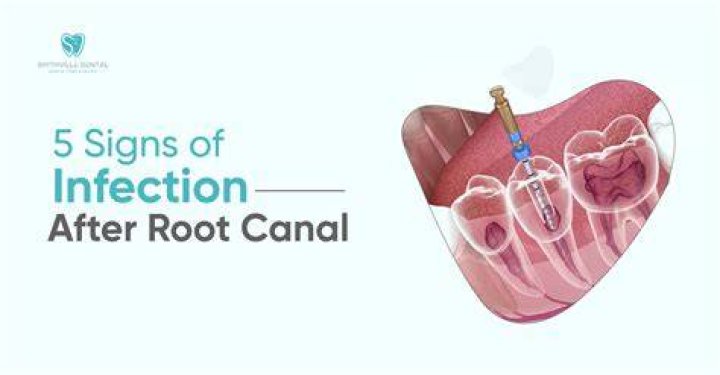What happens when a root canal gets infected?