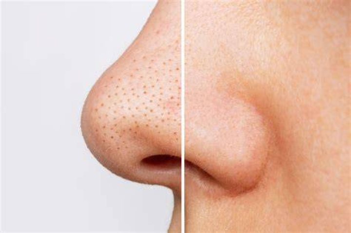 What is the seed of a blackhead?