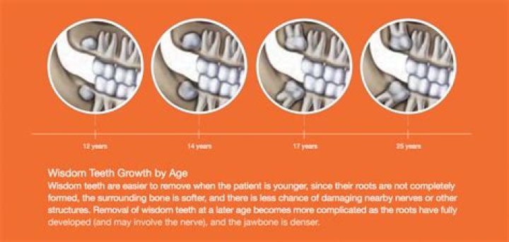 What is the youngest age you can get your wisdom teeth removed?