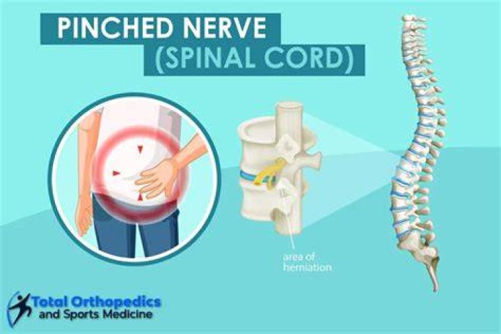 When does a pinched nerve need surgery?