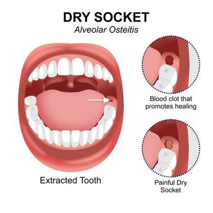 Which teeth are more prone to dry socket?