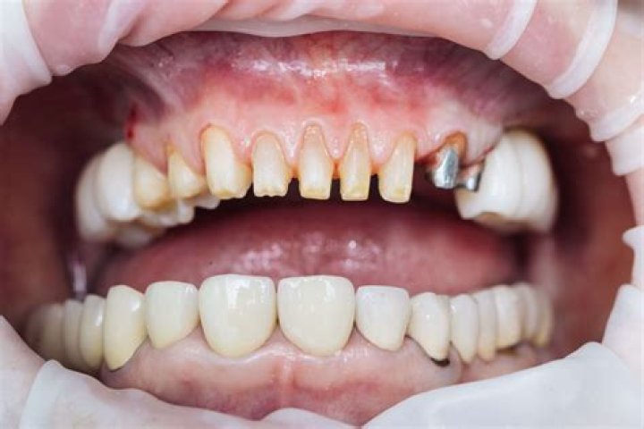 Why are teeth shaved down for crowns?
